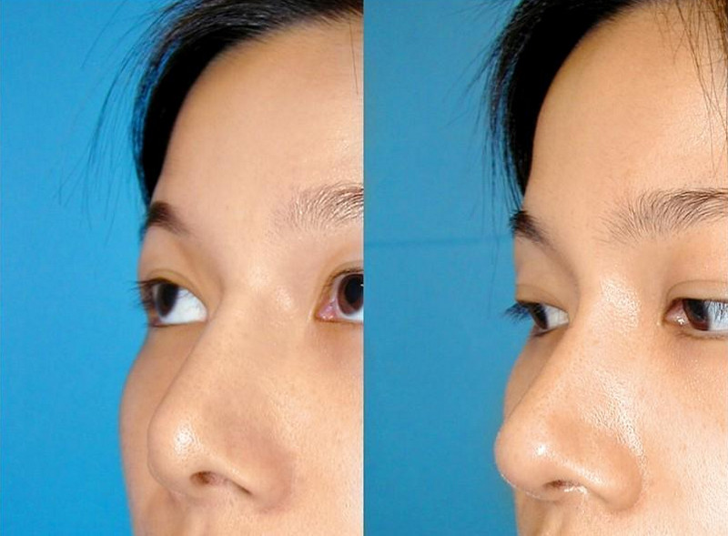 Nâng mũi cấu trúc giá bao nhiêu? Bảng giá tham khảo và các khoản cần biết 