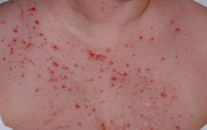 Cách trị viêm nang lông vùng kín theo mức độ: Từ chăm sóc tại nhà đến điều trị y khoa