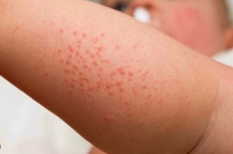 Cách trị viêm nang lông vùng kín theo mức độ: Từ chăm sóc tại nhà đến điều trị y khoa