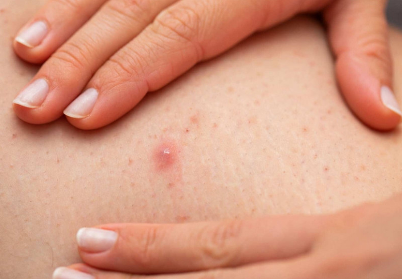 Cách trị viêm nang lông vùng kín theo mức độ: Từ chăm sóc tại nhà đến điều trị y khoa