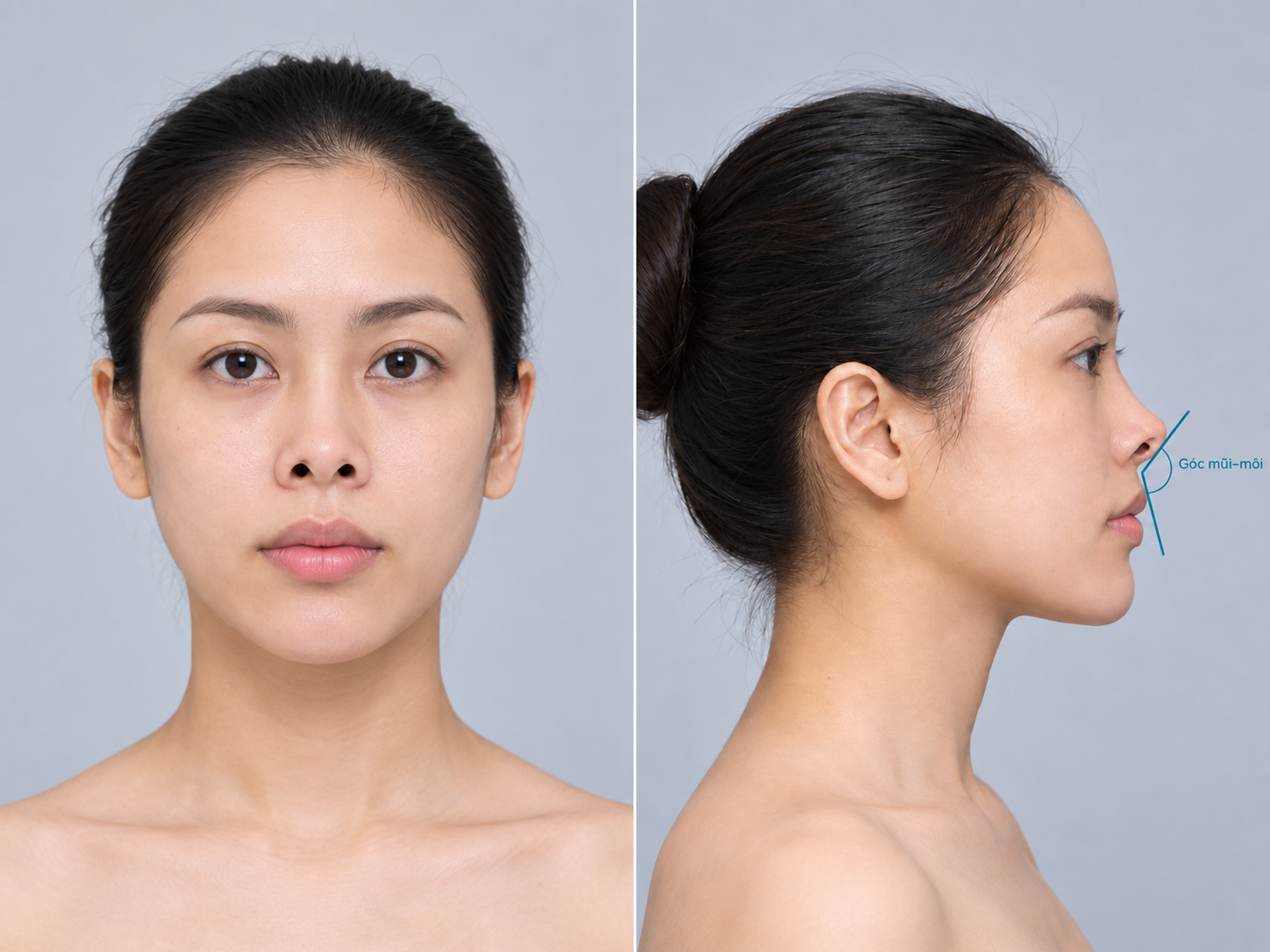Mũi hếch có sửa được không? Cách nhận biết và hướng khắc phục phù hợp
