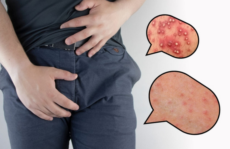 Viêm nang lông vùng kín nam giới do đâu? Khi nào cần đi khám?