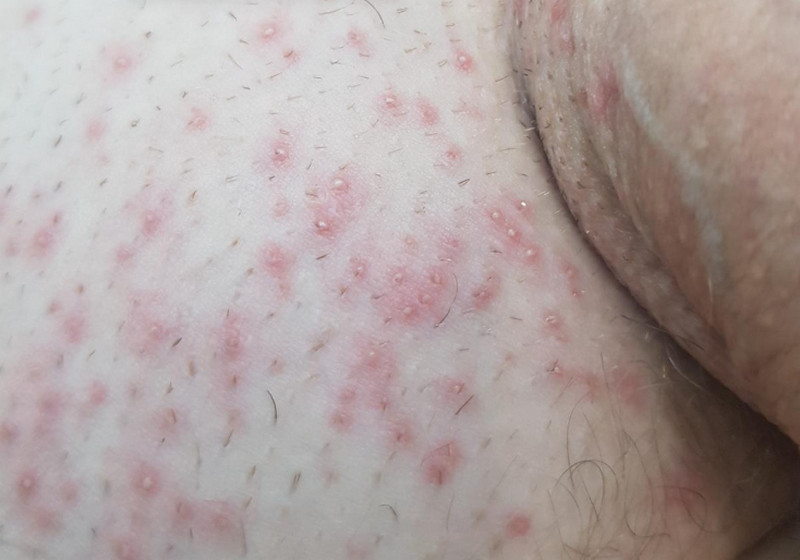 Viêm nang lông vùng kín nam giới do đâu? Khi nào cần đi khám?