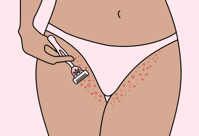 Viêm nang lông ở vùng kín nữ: Nguyên nhân, dấu hiệu và cách điều trị