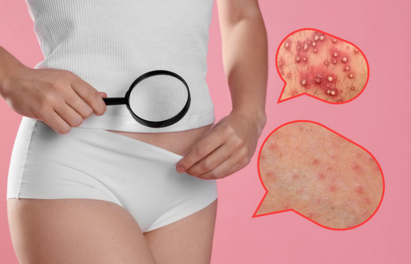 Viêm nang lông ở vùng kín nữ là gì? Phân biệt với mụn vùng kín