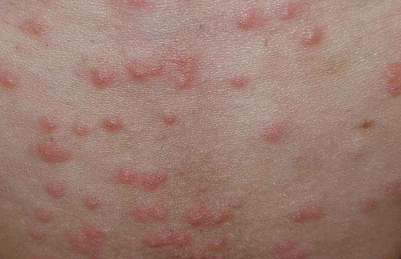 Viêm nang lông ở vùng kín nữ: Nguyên nhân, dấu hiệu và cách điều trị