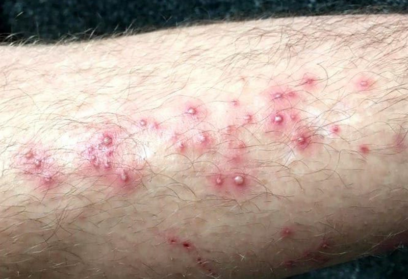 Viêm nang lông chân do đâu? Cách nhận biết và điều trị theo mức độ
