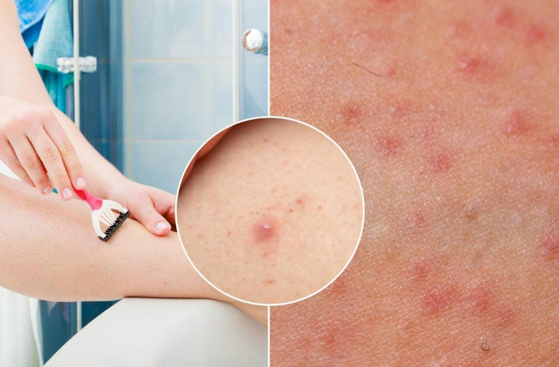 Trị viêm nang lông ở chân tại nhà 