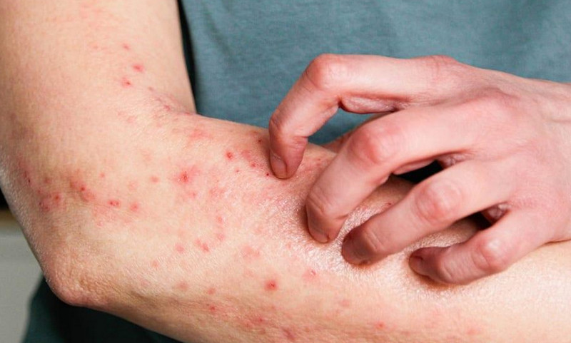 Cách trị viêm nang lông tại nhà: Nên làm gì, tránh gì và khi nào cần khám?