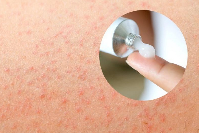 Cách trị viêm nang lông tại nhà: Nên làm gì, tránh gì và khi nào cần khám?
