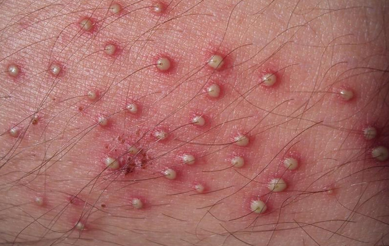 Cách trị viêm nang lông tại nhà: Nên làm gì, tránh gì và khi nào cần khám?